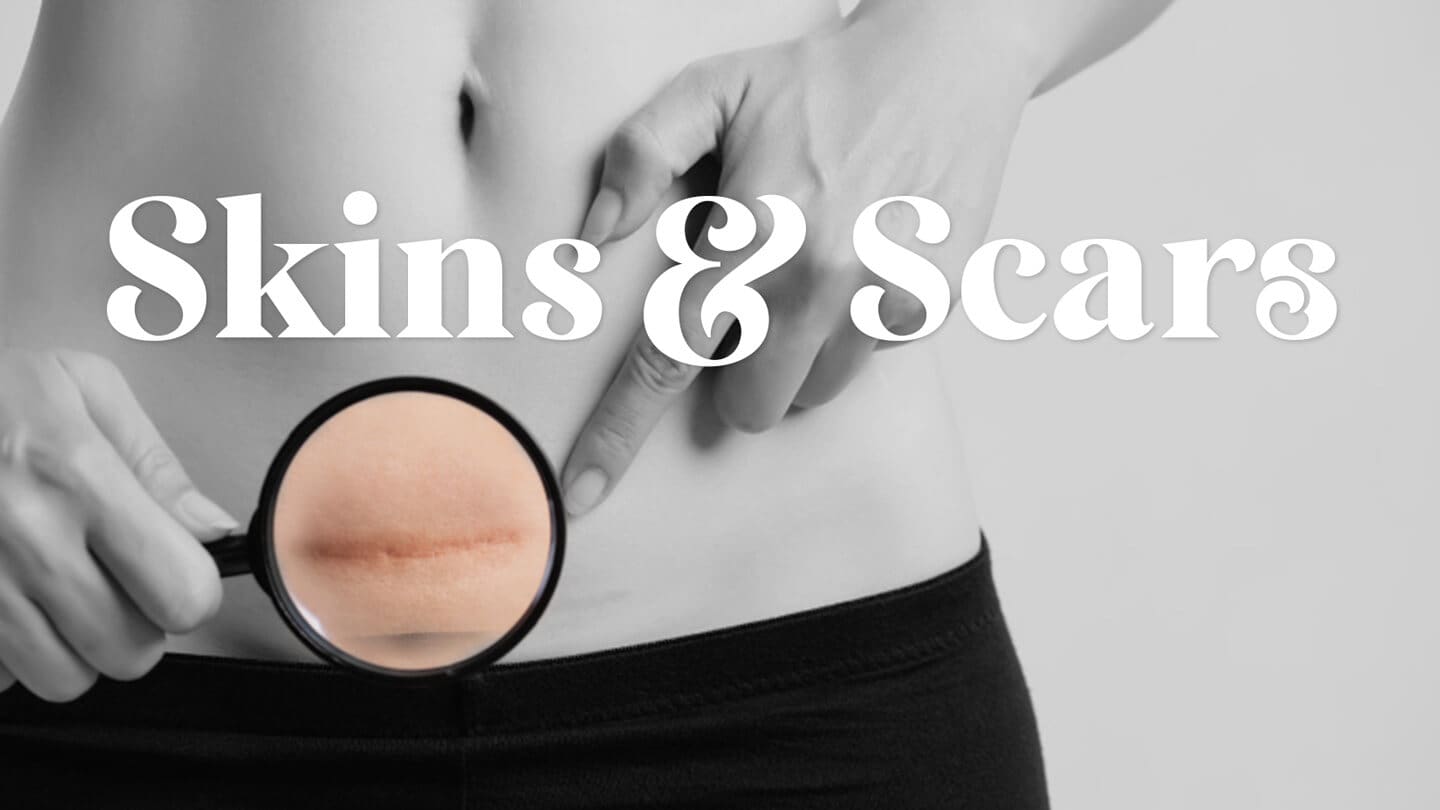 白斑・傷痕・妊娠線・スキンリジュビネーションコース